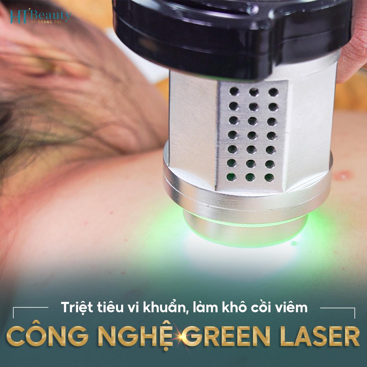 green laser