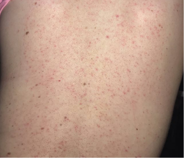 cách trị viêm nang lông ở lưng