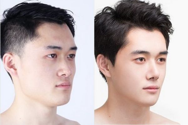NÂNG MŨI CHỈ LÀ PHƯƠNG PHÁP LÀM ĐẸP KHÔNG PHẪU THUẬT GIÚP NÂNG SỐNG MŨI TẠM THỜI