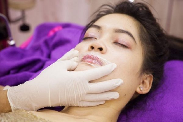 Ưu điểm tiêm filler môi