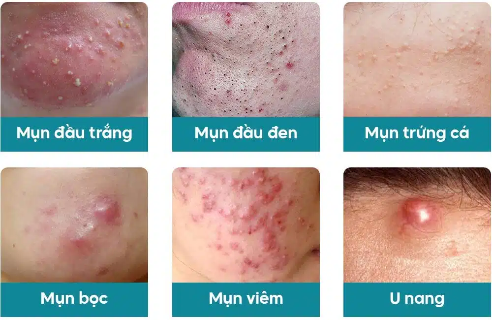 Các loại mụn thường gặp