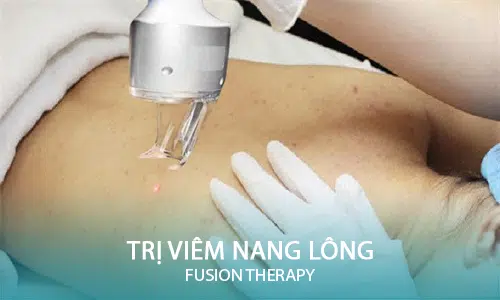 Trị viêm nang lông Fusion Therapy