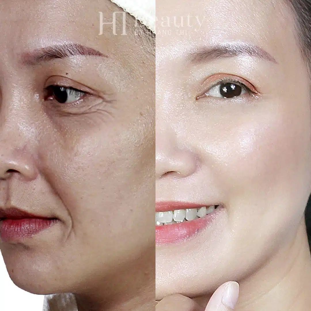 Khách hàng trẻ hóa da tại HT Beauty