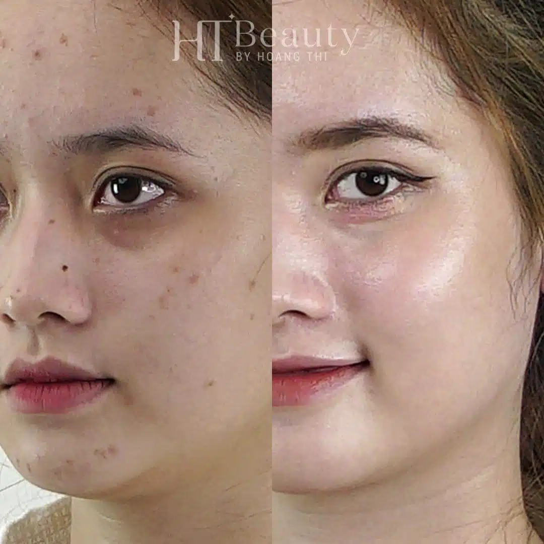 Khách hàng điều trị mụn tại HT Beauty