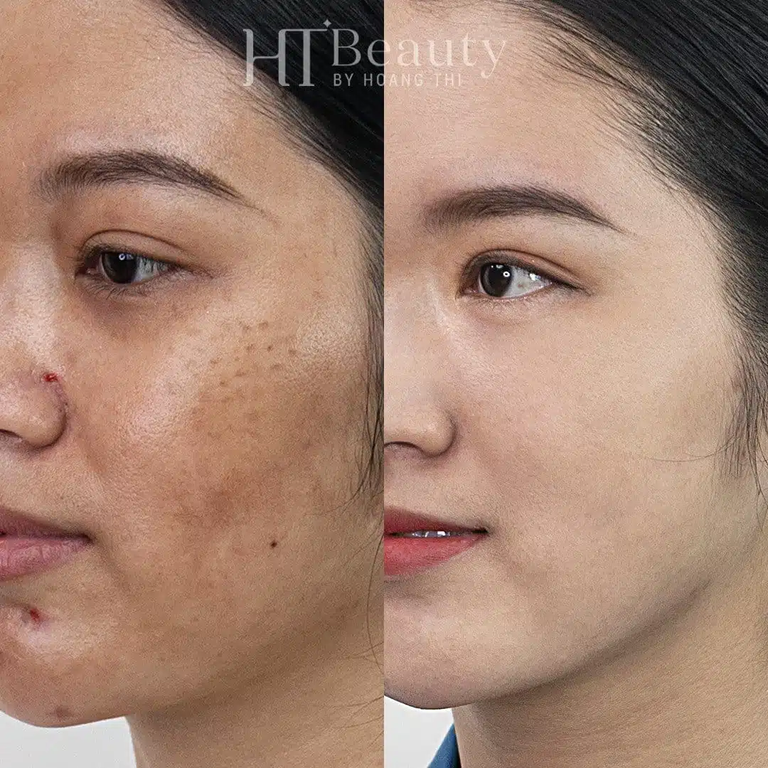 Khách hàng trắng sáng da tại HT Beauty