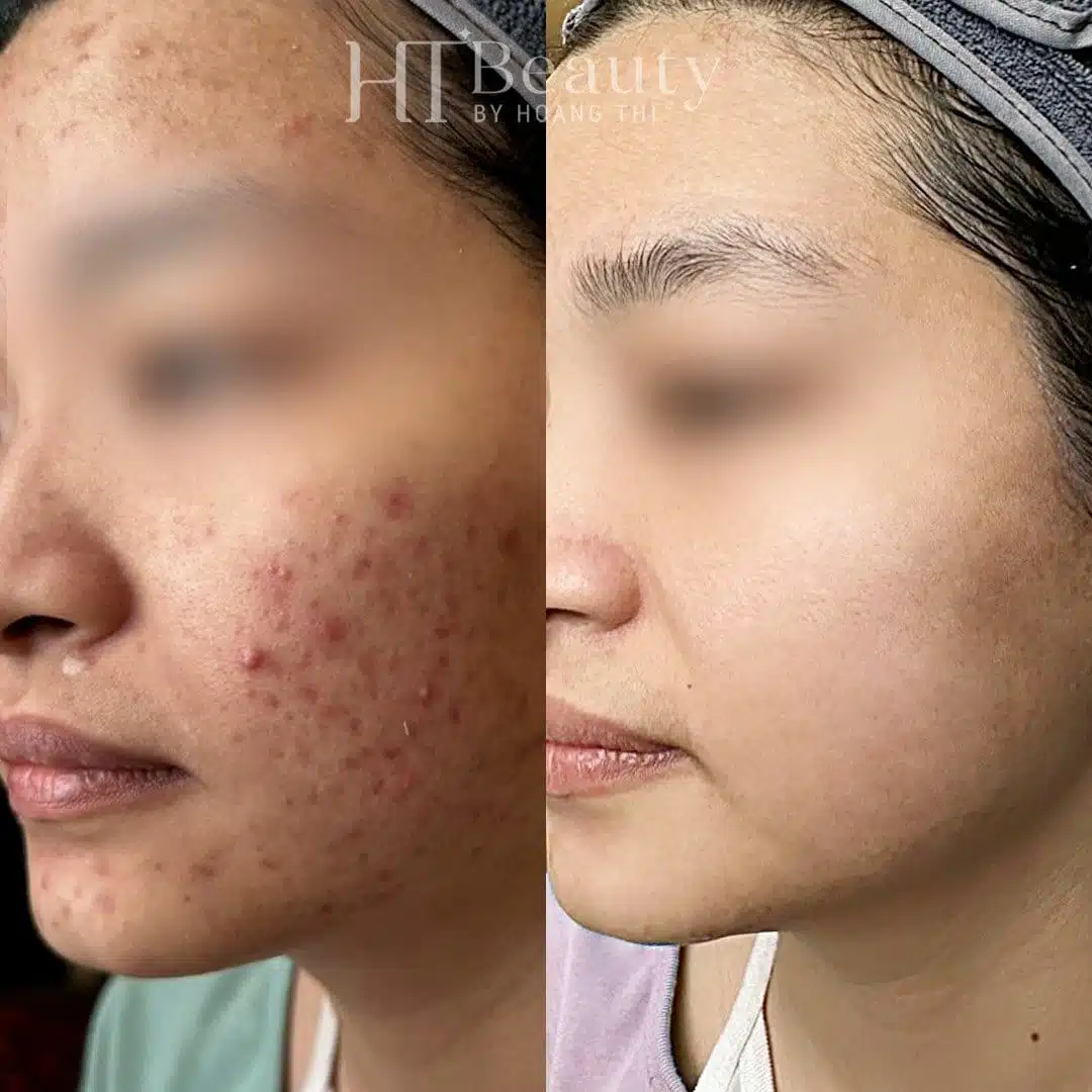 Khách hàng điều trị mụn tại HT Beauty