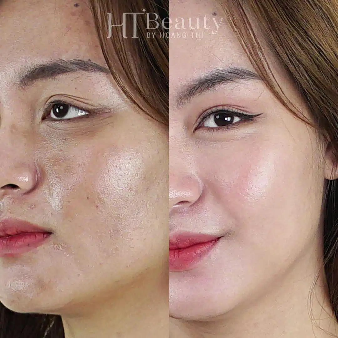 Khách hàng trắng sáng da tại HT Beauty