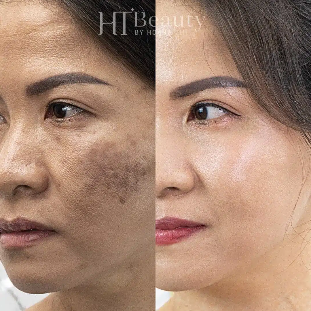 Khách hàng điều trị nám da tại HT Beauty