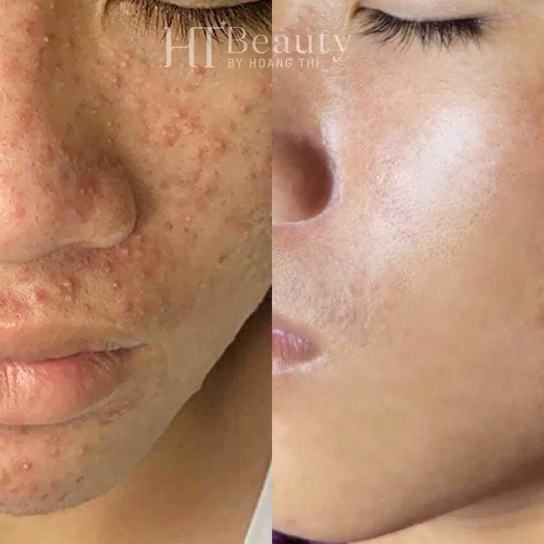Khách hàng điều trị mụn tại HT Beauty