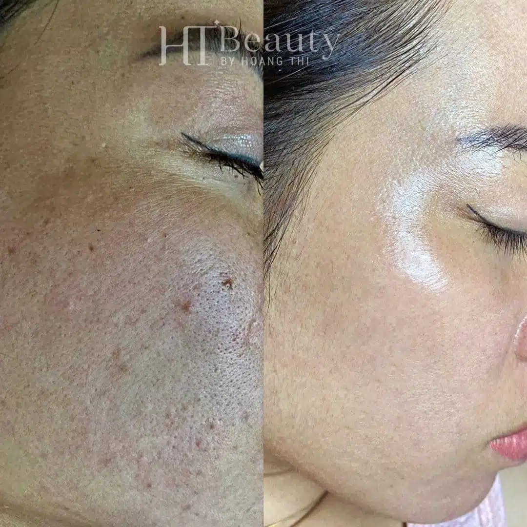 Khách hàng điều trị nám da tại HT Beauty