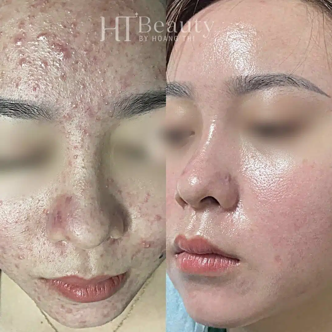 Khách hàng điều trị mụn tại HT Beauty