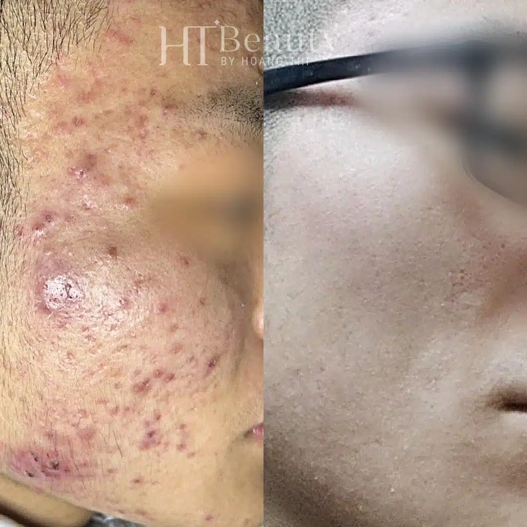Khách hàng điều trị mụn tại HT Beauty