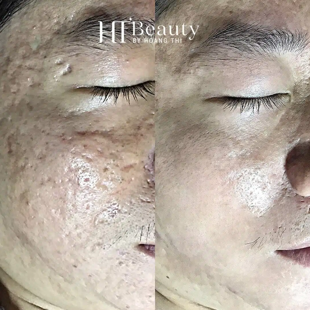 Khách hàng điều trị sẹo tại HT Beauty