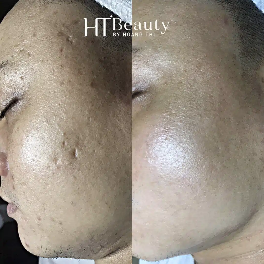 Khách hàng điều trị sẹo tại HT Beauty