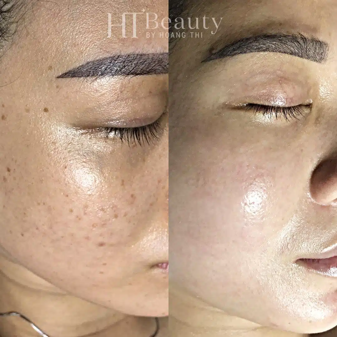 Khách hàng trị nám da tại HT Beauty