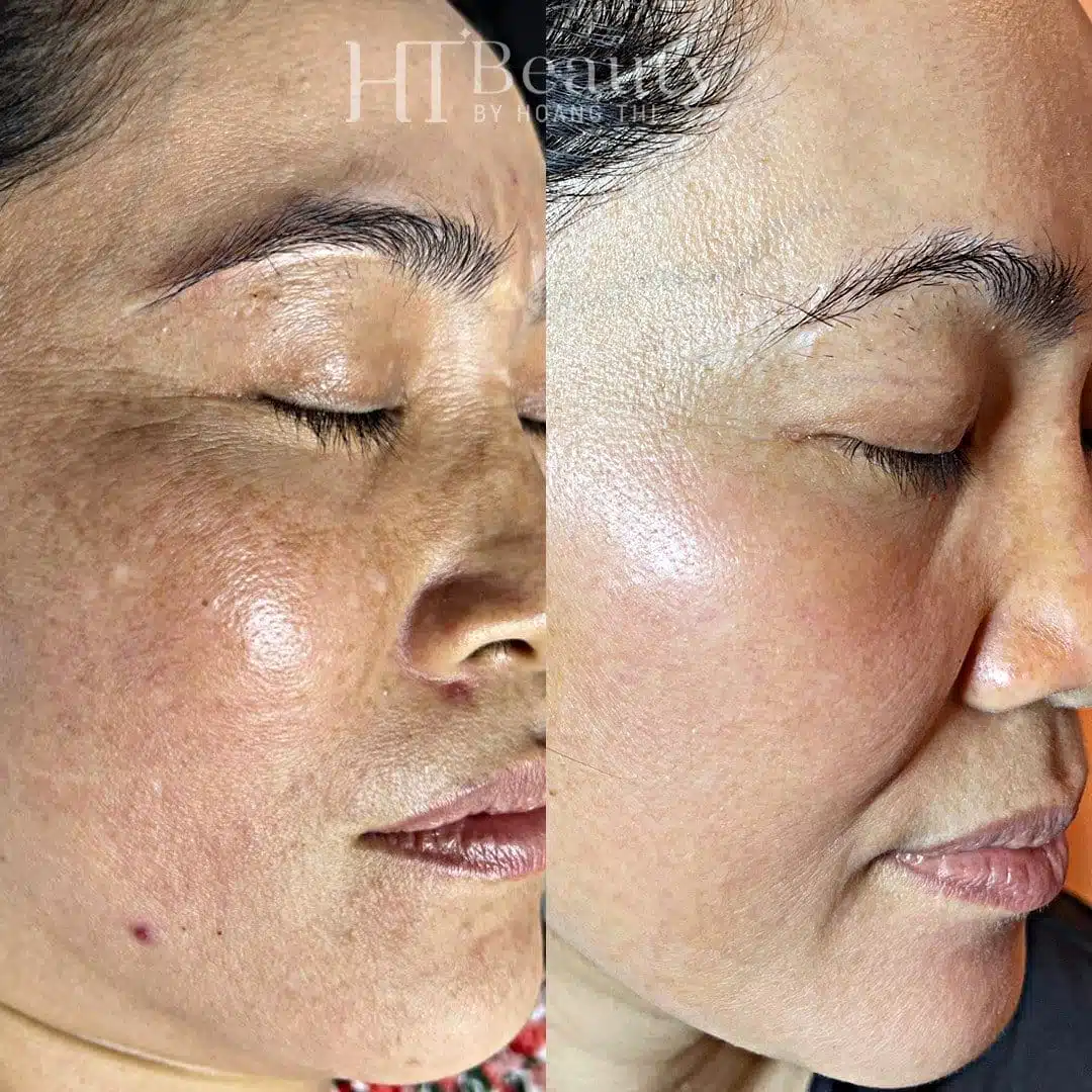 Khách hàng trị nám da tại HT Beauty