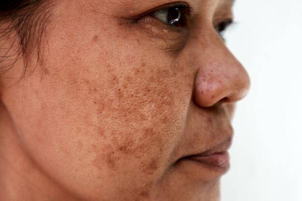 Tác hại của việc trị nám bằng laser rối loạn sắc tố da