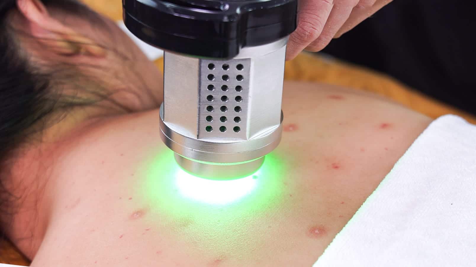 Công nghệ Green Laser điều trị mụn lưng
