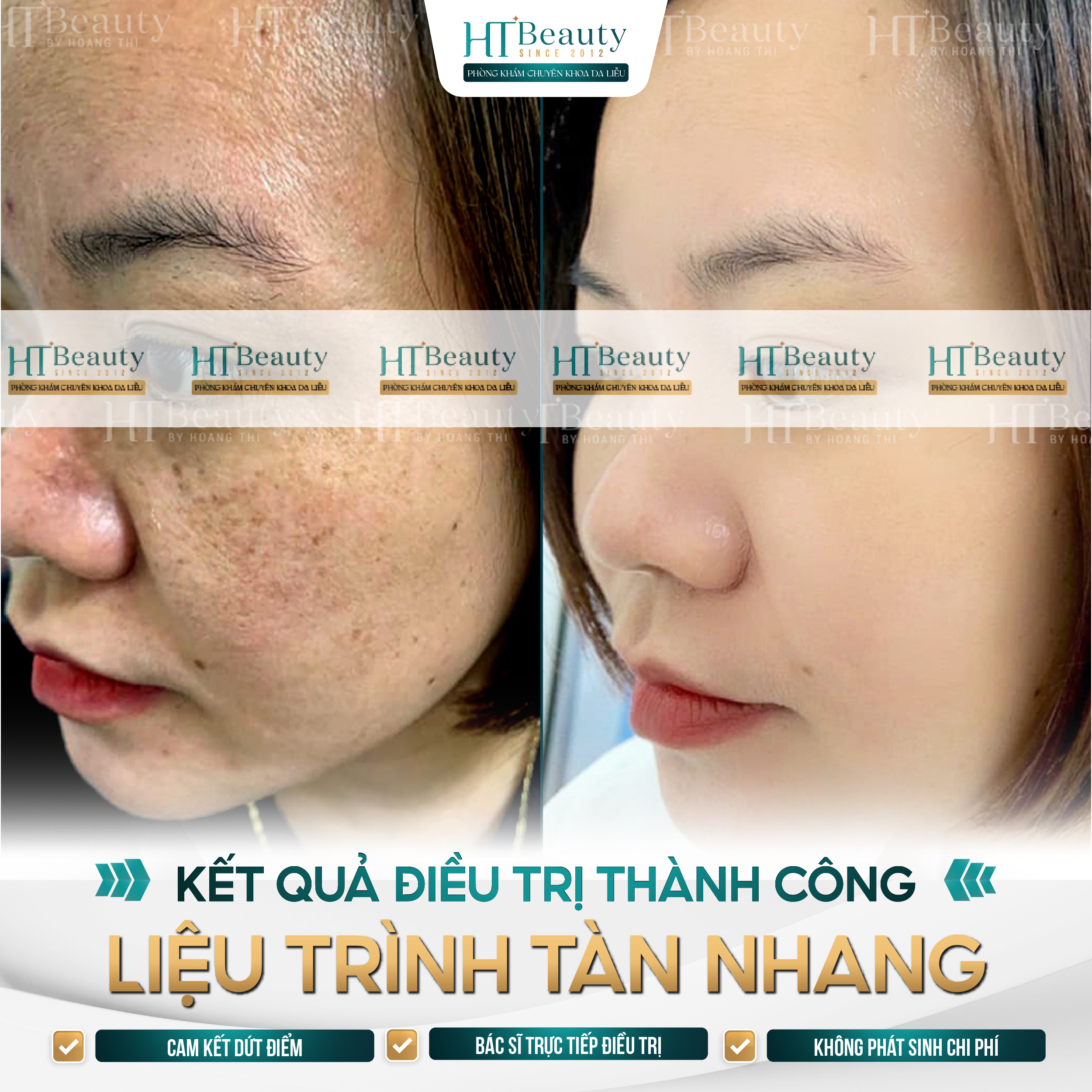 KẾT QUẢ ĐIỀU TRỊ THÀNH CÔNG LIỆU TRÌNH ĐIỀU TRỊ TÀN NHANG CỦA KHÁCH HÀNG HT BEAUTY