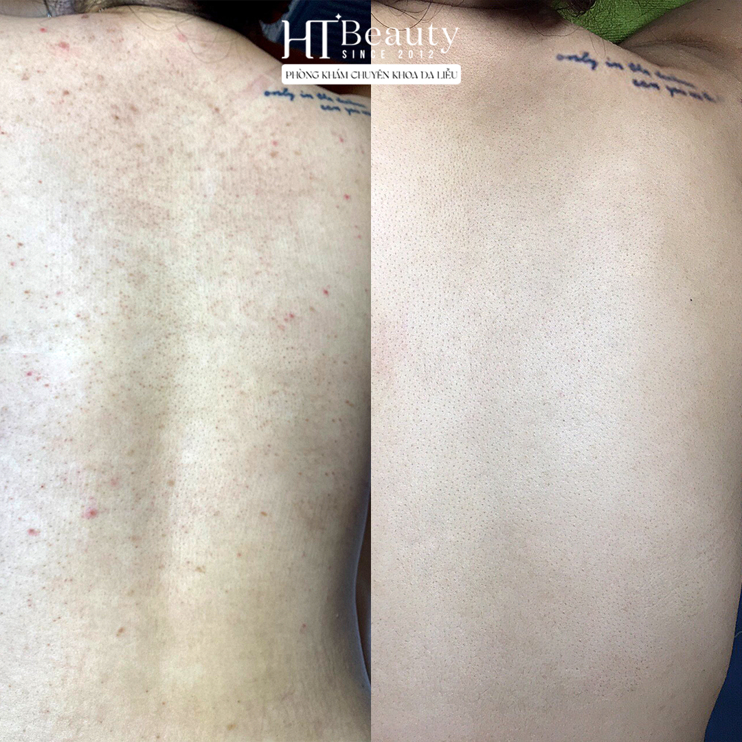 viem nang long vung lung bf