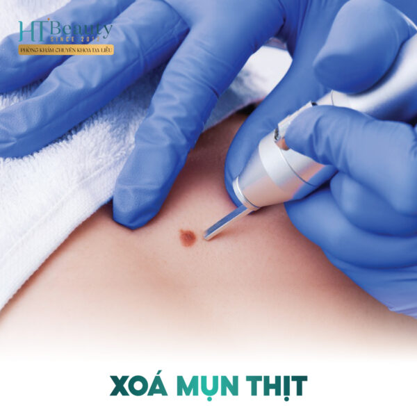 xam not ruoi 1