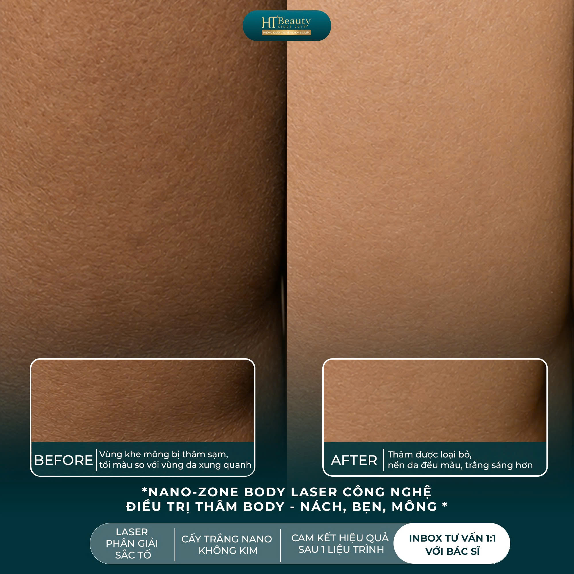 Hiệu quả Laser trị thâm mông tại Phòng khám HT Beauty