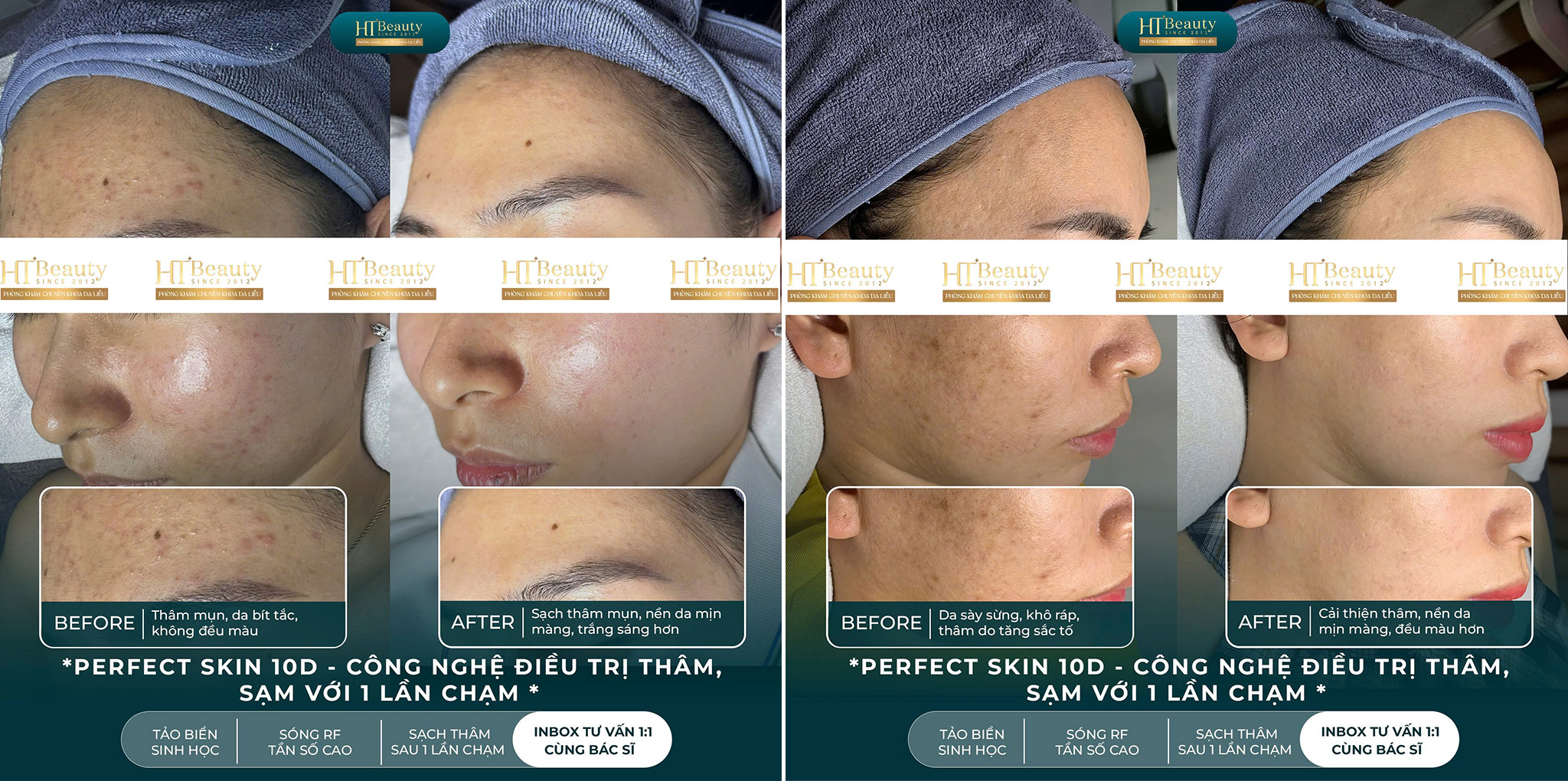 Kết quả điều trị thâm mụn