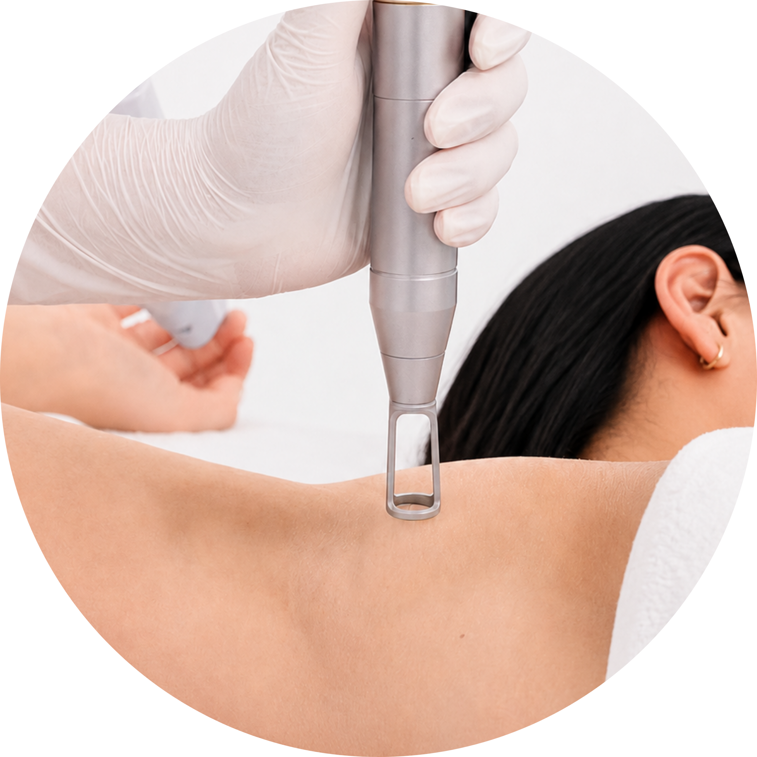 ND:YAG Laser