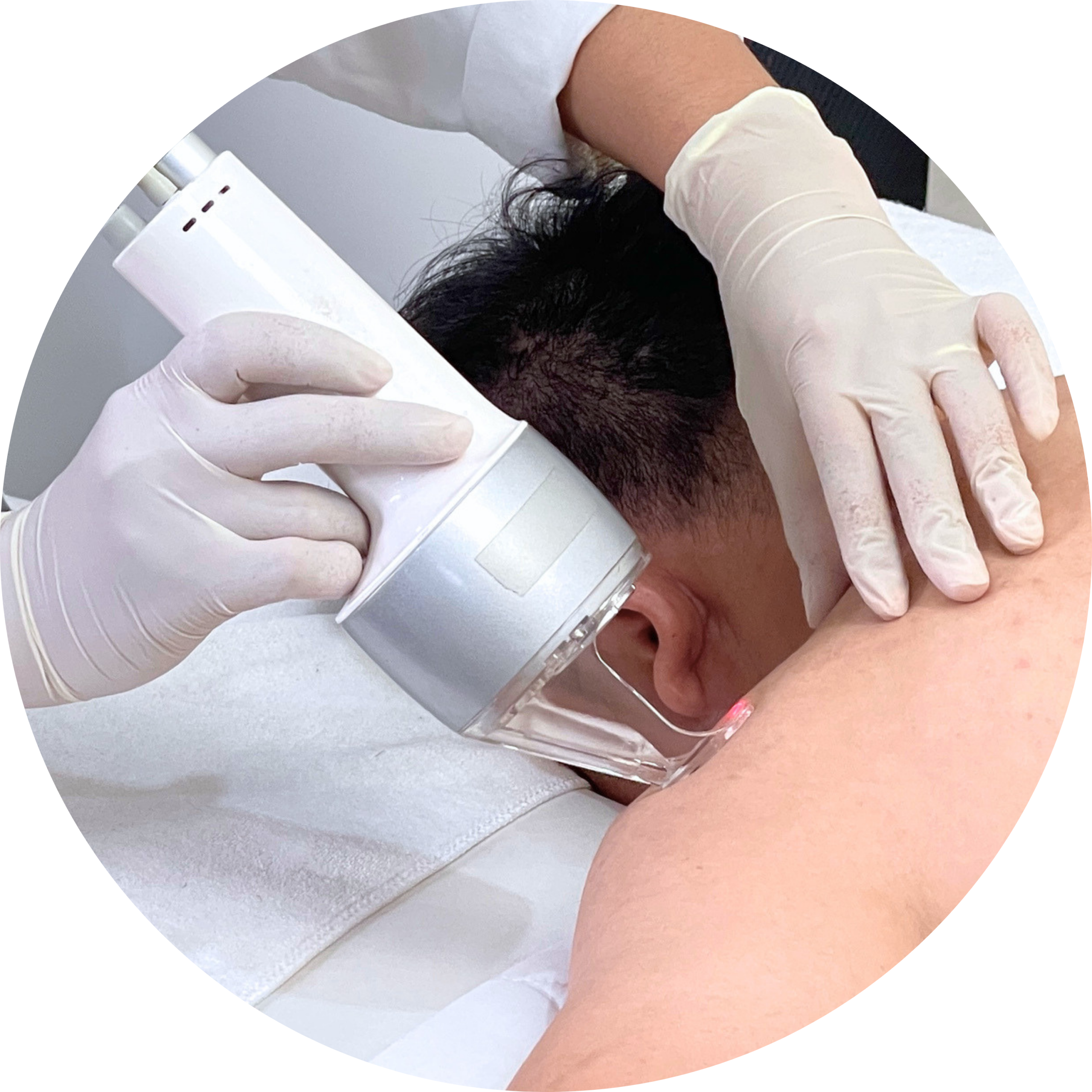 CO2 Fractional