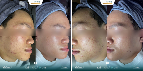 Điều trị mụn chuyên sâu
