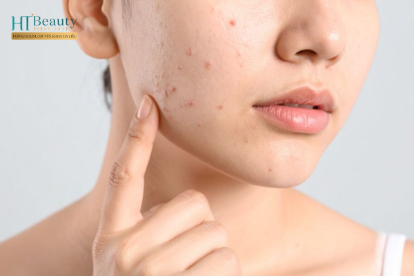 Ngủ sớm là một điều kiện cần nhưng chưa đủ để điều trị mụn
