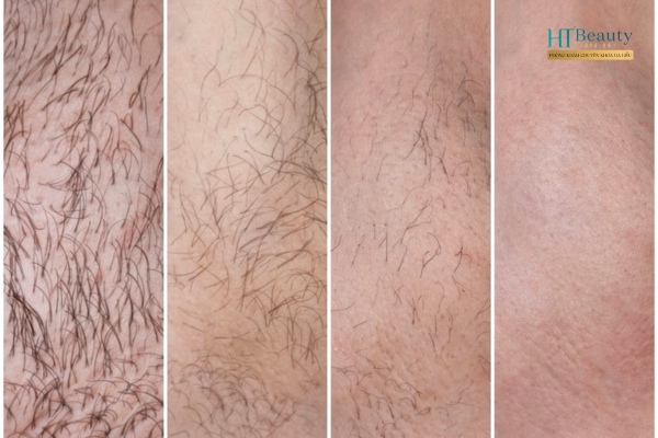 Hiệu quả triệt lông công nghệ cao tại HT Beauty