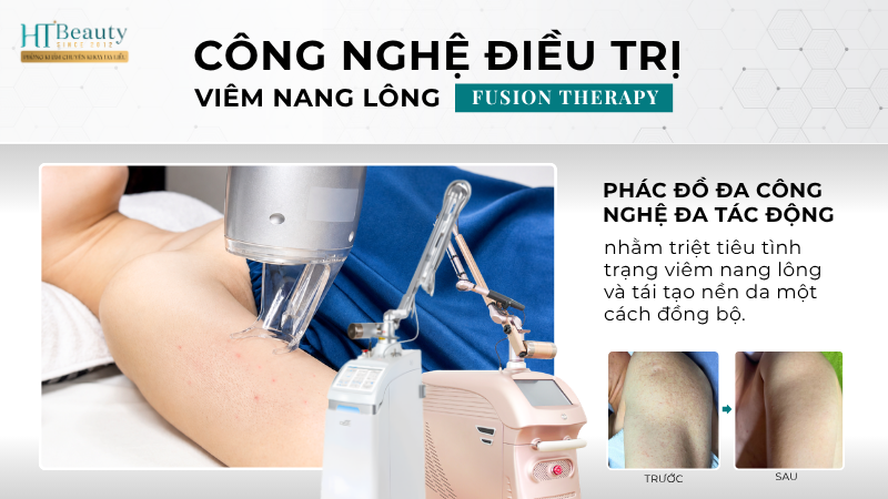 Các vị trí dễ bị viêm nang lông trên cơ thể