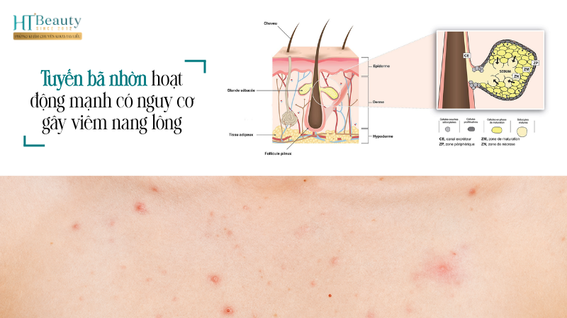 Các vị trí dễ bị viêm nang lông trên cơ thể