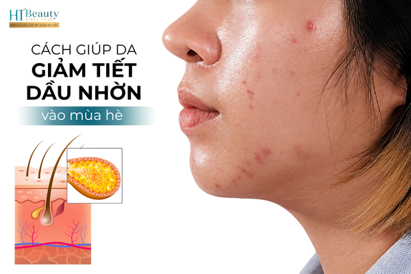 Cách giúp da giảm tiết dầu nhờn vào mùa hè