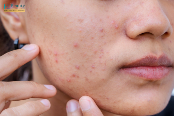 Cách giúp da giảm tiết dầu nhờn vào mùa hè 