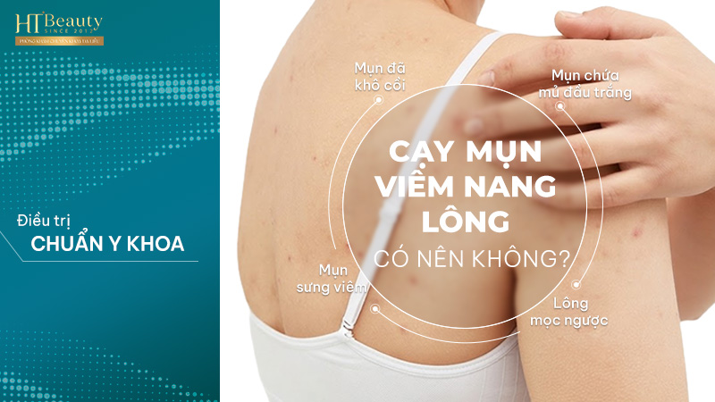 Có nên tự cạy nốt mụn viêm nang lông không