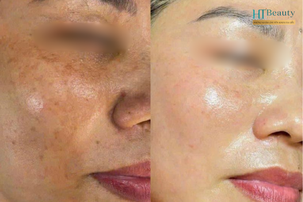 8 Lưu ý chăm sóc da nám tại nhà