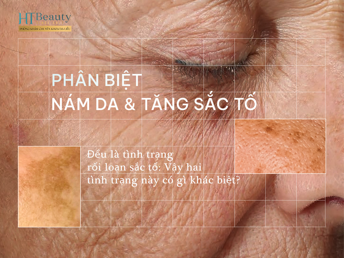 Phân biệt Nám da và Tăng sắc tố sau viêm: Nhầm lẫn phổ biến trong điều trị rối loạn sắc tố