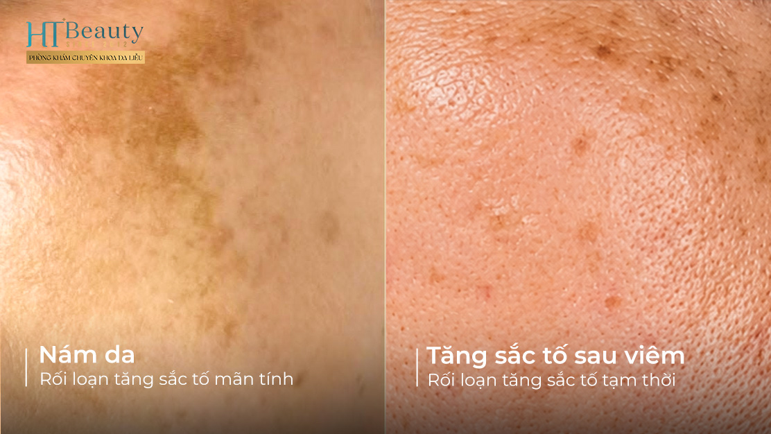 Phan biet Nam da va Tang sac to sau viem Nham lan pho bien trong dieu tri roi loan sac to3