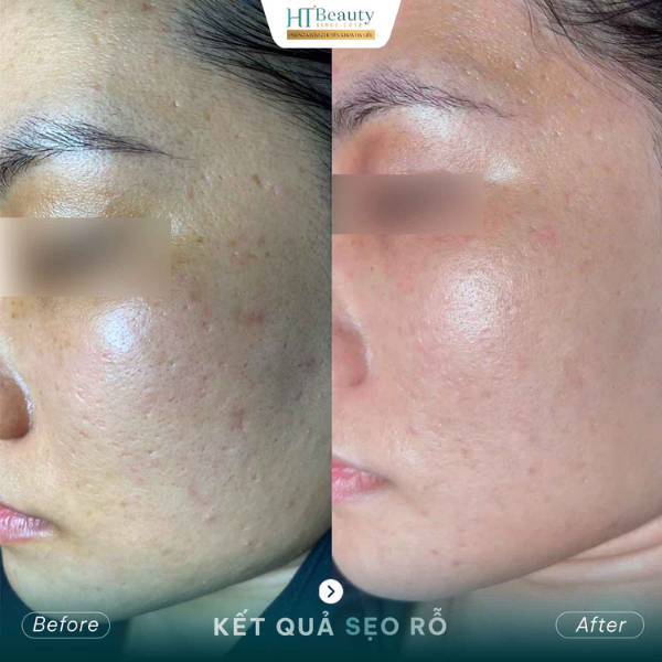 Vì sao nên điều trị sẹo rỗ sớm