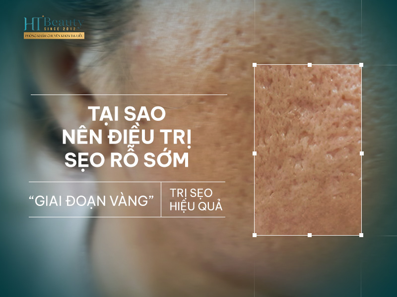 Vì sao nên điều trị sẹo rỗ sớm