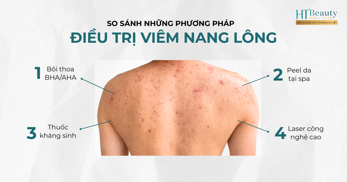 So sánh những phương pháp điều trị viêm nang lông