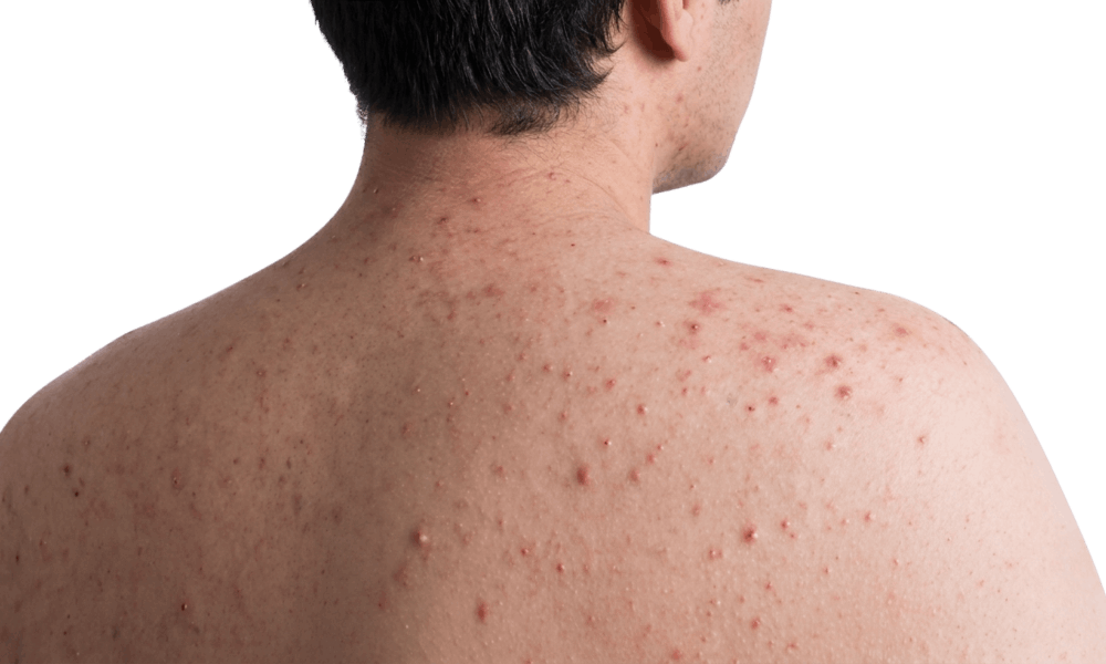 Điều trị viêm nang lông tại nhà được không?