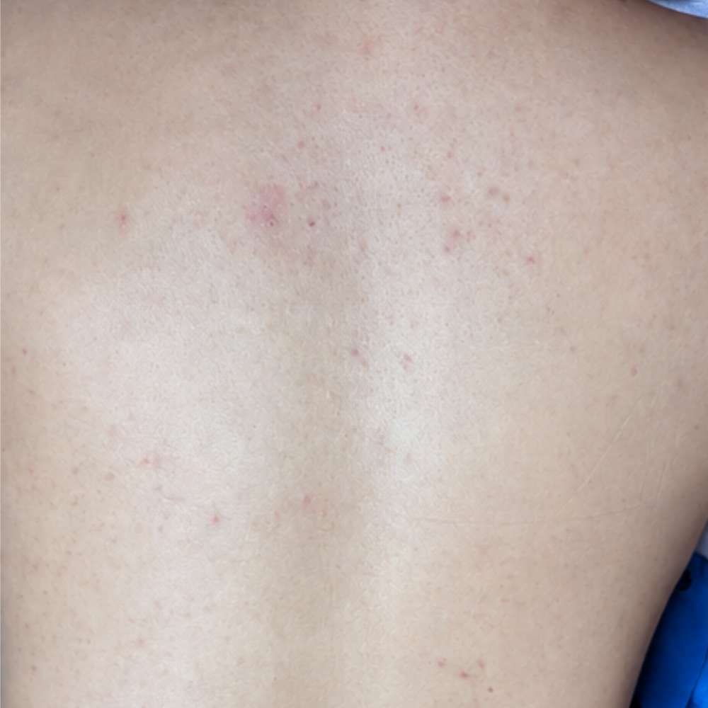 Giai đoạn 2 kiểm soát viêm sâu