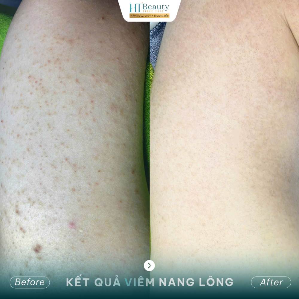 Kết quả điều trị 4
