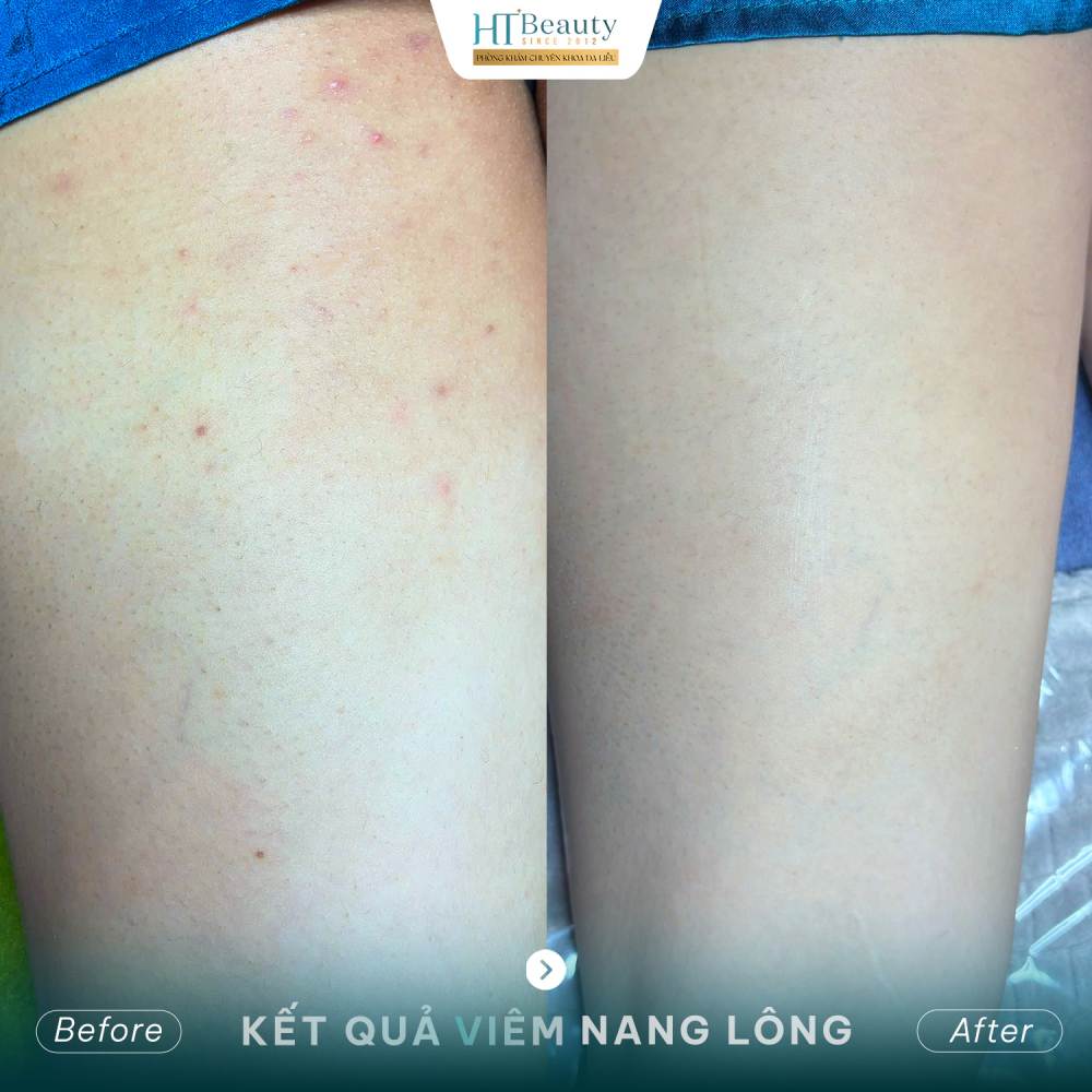 Kết quả điều trị 3