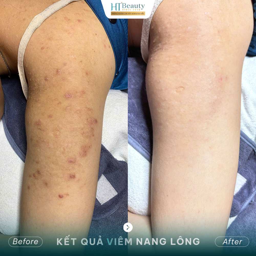 Kết quả điều trị 1