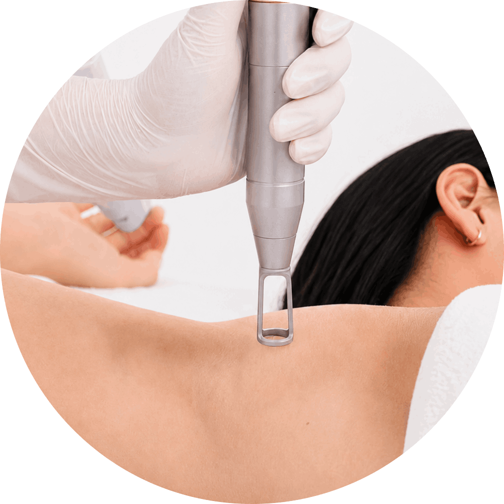 ND:YAG Laser