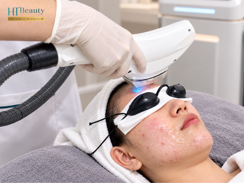 Laser điều trị mụn